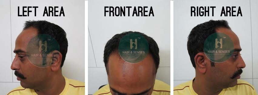 Before Procedure Girish Chawdhary